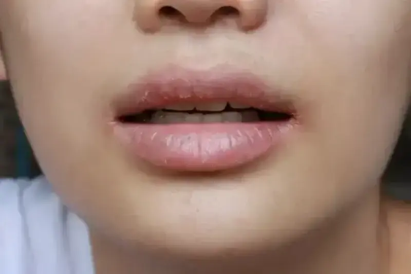ปากแห้ง เกิดจากอะไร รักษาอย่างไรให้หายขาด