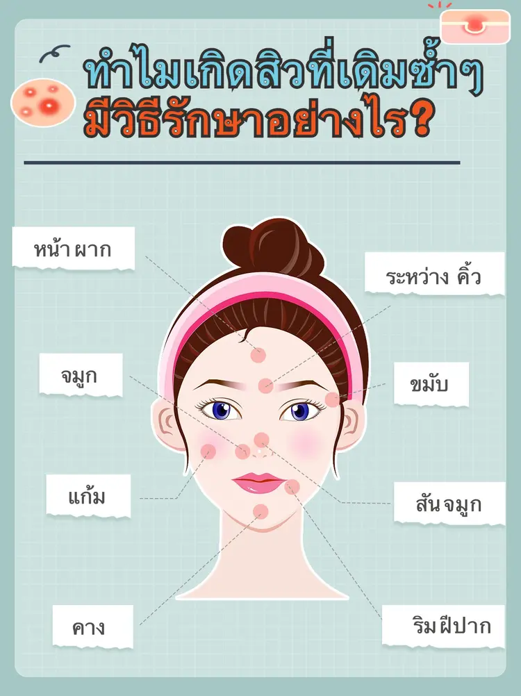 ⭐️สิวที่เกิดขึ้นซ้ำในตำแหน่งเดียวกันบ่อยๆ มักเกี่ยวข้องกับปัจจัยภายในร่างกายและพฤติกรรมในชีวิตประจำวัน ต่อไปนี้คือสาเหตุหลักๆ ที่ทำให้สิวขึ้นในจุดเดิมๆ