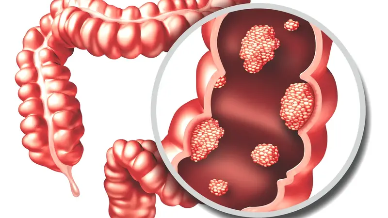 มะเร็งลำไส้ใหญ่ (Colorectal Cancer)