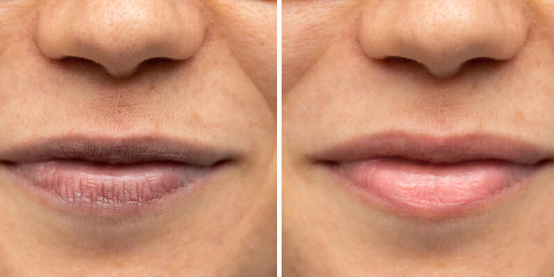 ปากดำ ปากดูคล้ำ ริมฝีปากมีสีเข้ม แก้ไขด้วยอะไรได้บ้าง - First Clinic